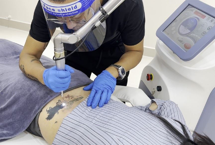 Best Picosecond Laser Machine