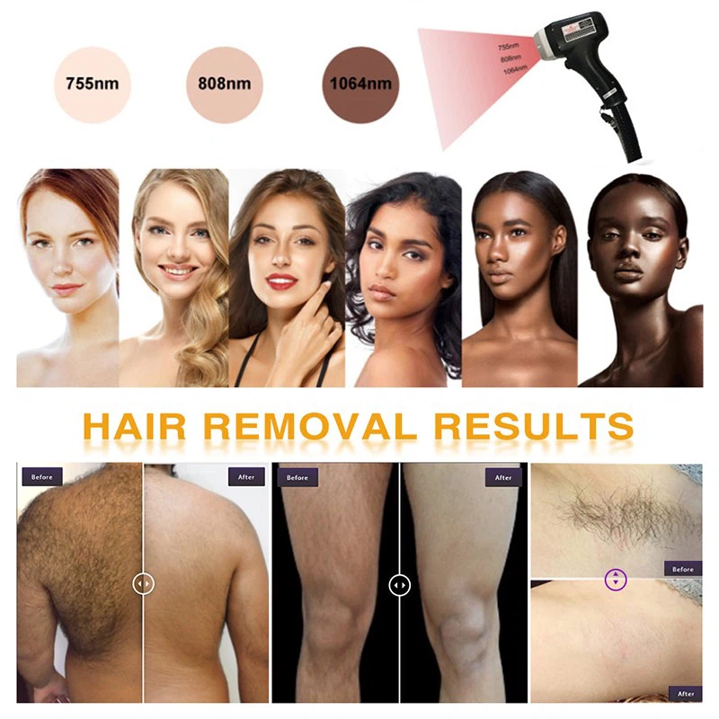 Factory Price Soprono Diode Laser Hair Removal Machine