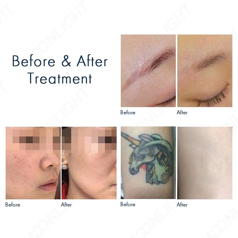 Multifunctional Laser Hair Removal Machine