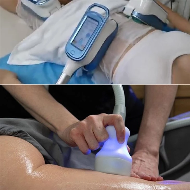 Coolsculpting Machine náklady