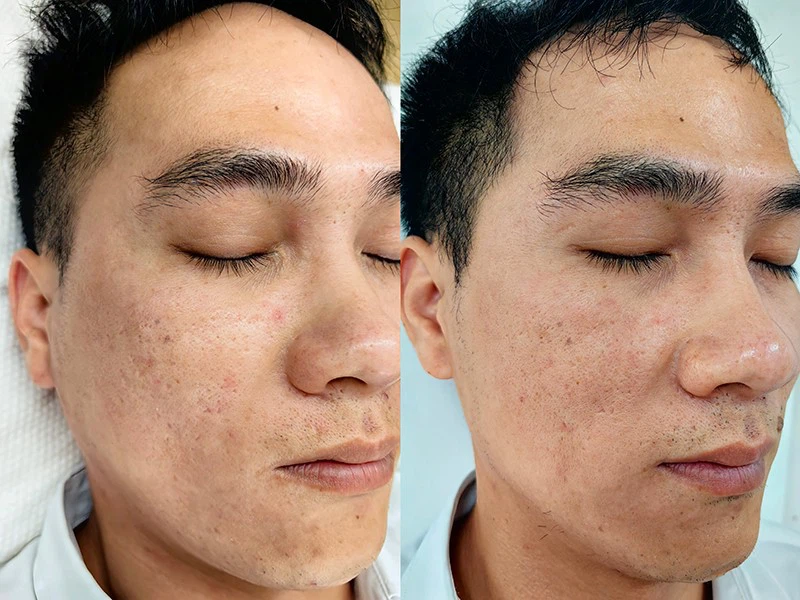 RF Beauty Crystallite Depth 8 For Skin Firming Face Lifting